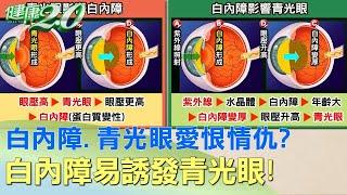 白內障vs.青光眼愛恨情仇？白內障易誘發青光眼！ 健康2.0