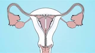 Hormonal coil (IUS)