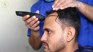 SAPPHIRE FUE Hair Transplant | New Roots Hair Transplant Kolkata | #sapphirehairtransplant