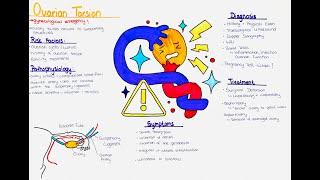 Understanding Ovarian Torsion: Risk Factors, Pathophysiology, Symptoms, Diagnosis, Treatment