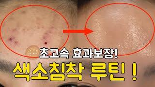 진짜 빠른 효과 보장 Only 홈케어로만 색소침착 없애는 루틴 (여드름 압출 망하고 싶지 않으면 꼭 보세요...)