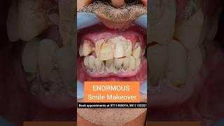 ENORMOUS Smile Makeover in 10 days; Dr. Srishti Bhatia #teeth #dental #dr