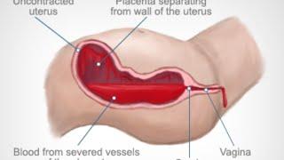 Postpartum Hemorrhage