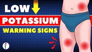 Signs of Low Potassium and Natural Treatment | Potassium Deficiency | Hypokalemia