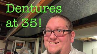 Getting dentures at 35. My story before extraction & Immediate dentures