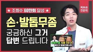 발톱무좀 치료 60만 기념 Q&A (발톱무좀약, 발톱무좀 뽑기, 발톱무좀 민간요법)