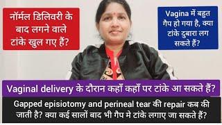 नॉर्मल डिलिवरी के बाद टांके खुल गए हैं । Gapped episiotomy और perineal tear repair कब की जाती है?