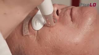 PicoLO Laser - #Acne #Scar #Treatment