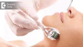 What is Derma Roller Treatment for Acne Scars? - Dr. Urmila Nischal