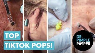 Dr Pimple Popper’s Top 10 Tiktok Pops