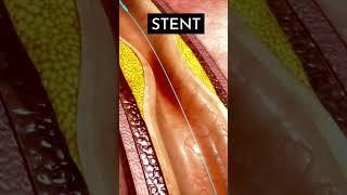 हार्ट के ब्लॉकेज कम करने का आसान उपाय Heart Blockage Explained in 3D Animation