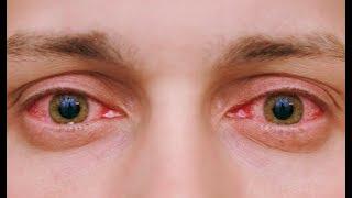 Как убрать красные глаза: 10 домашних способов