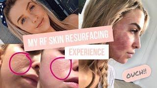 My RF Skin Resurfacing Experience