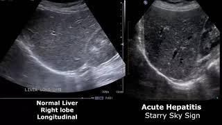 Liver Ultrasound Normal Vs Abnormal Image Appearances Comparison | Liver Ultrasound Pathologies