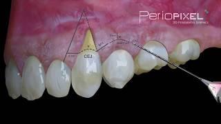 3D dental video - Laterally Moved and Coronally Advanced Flap - PerioPixel