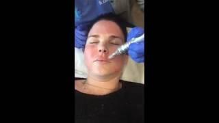 Microneedling Demonstration