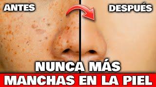 Con SOLO 1 USO ELIMINARÁS las MANCHAS de la PIEL y MARCAS del ACNÉ | Remedio Casero Manchas Oscuras