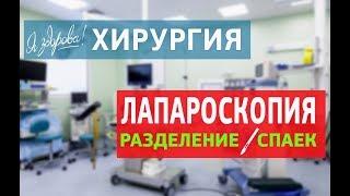 Лапароскопия. Разделение спаек