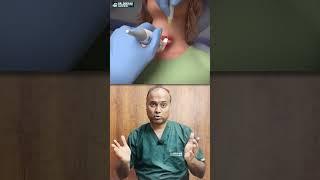 How Is Simple Aspiration Used for Cystic Thyroid Nodules? | Best Treatment of Thyroid in Jaipur