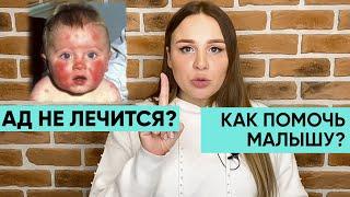 КАК ВЫЛЕЧИТЬ АТОПИЧЕСКИЙ ДЕРМАТИТ? Действенные способы для здоровья малыша. Ника Болзан