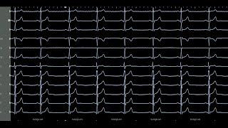 Continuous 12-Lead Electrocardiogram During Vertebral Vein Stimulation for Induction of PVCs