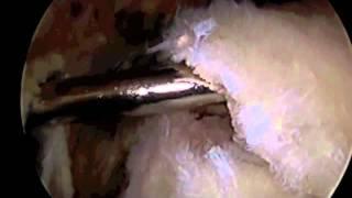 Rotator Cuff Repair Arthroscopic Shoulder Surgery-Dr. Eric Janssen