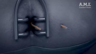 Comfort Drain Anorectal Fistula Long-Term Draining System