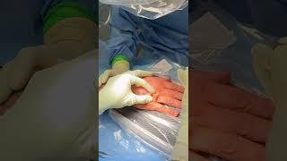 Removal Foreign Body Left Hand (Pellet)