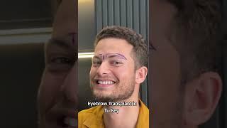 Eyebrow Transplant Transplant in Turkey | Eyebrow Transplant in Turkey  #eyebrowtransplant