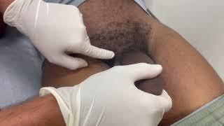 Deflating A Penile Prosthesis