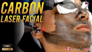 Carbon Laser Facial Treatment for Skin Glow | Sakhiya Skin Clinic