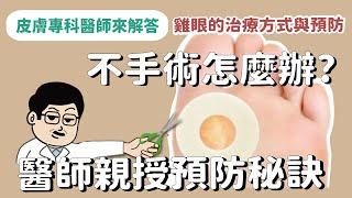 【皮膚專科醫師來解答】雞眼如何根除與預防?有哪些治療方式?皮膚專科醫師親授超簡單預防雞眼疼痛的方法