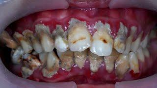 25yo. MALE | TARTAR INVASION | SCALING | Dentist | Dokter Gigi Tri Putra