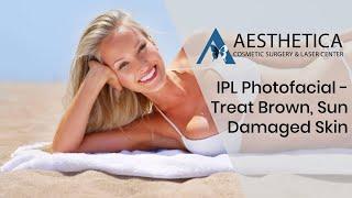 IPL Photofacial to treat Brown Sun-Damaged Skin - Phillip Chang M.D. - www.gotobeauty.com - 703-729