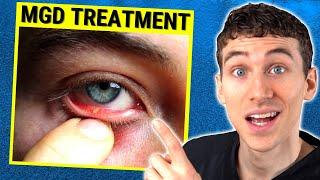 MGD (Dry Eye) Treatment Guide - How to Treat Meibomian Gland Dysfunction