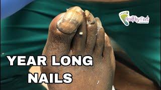 Year Old Long Toenails!