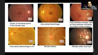 Management of Diab. Retinopathy. An update for the General Ophthalmologists-Dr.Rajiv Raman
