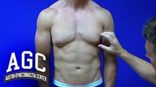 Gynecomastia Treatment Explained - Austin Gynecomastia Center