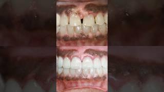 It can be done! Not all teeth need to be restored for a Hollywood smile 