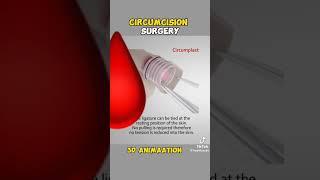 Understanding Circumcision: Animated Surgery & Real Insights"