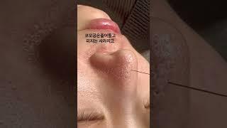 딸기처럼 구멍숭숭뚫린 모공도 꽉차있는 블랙헤드도 없애는 깨끗하고 뽀얀 코만들기콜드플라즈마