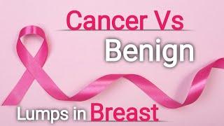 Benign Vs Malignant Breast Lesions on Ultrasound| Cancer Vs Non cancerous lumps of breast| Breast