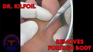 Dr. Kilfoil Removes A Foreign Body From Foot!