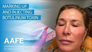 Marking Up and Injecting Botulinum Toxin