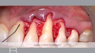 Treatment of gingival recession with a Coronally Advanced Flap by Prof Andrea Pilloni