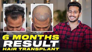 Hair Transplant in India | Best Results & Cost of Hair Transplant in India