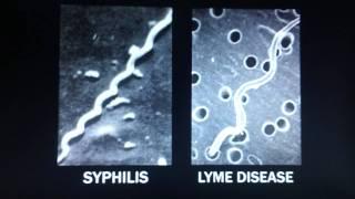 Under Our Skin - Dr. McDonald Clip, Lyme Disease, Alzhemer's, MS,