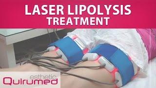 Laser Lipolysis Treatment (734-BL009)