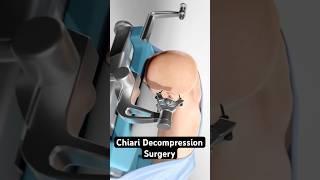 Correcting a bulging brain (Chiari Malformation)