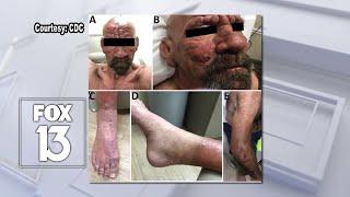 Leprosy considered 'endemic' to Central Florida